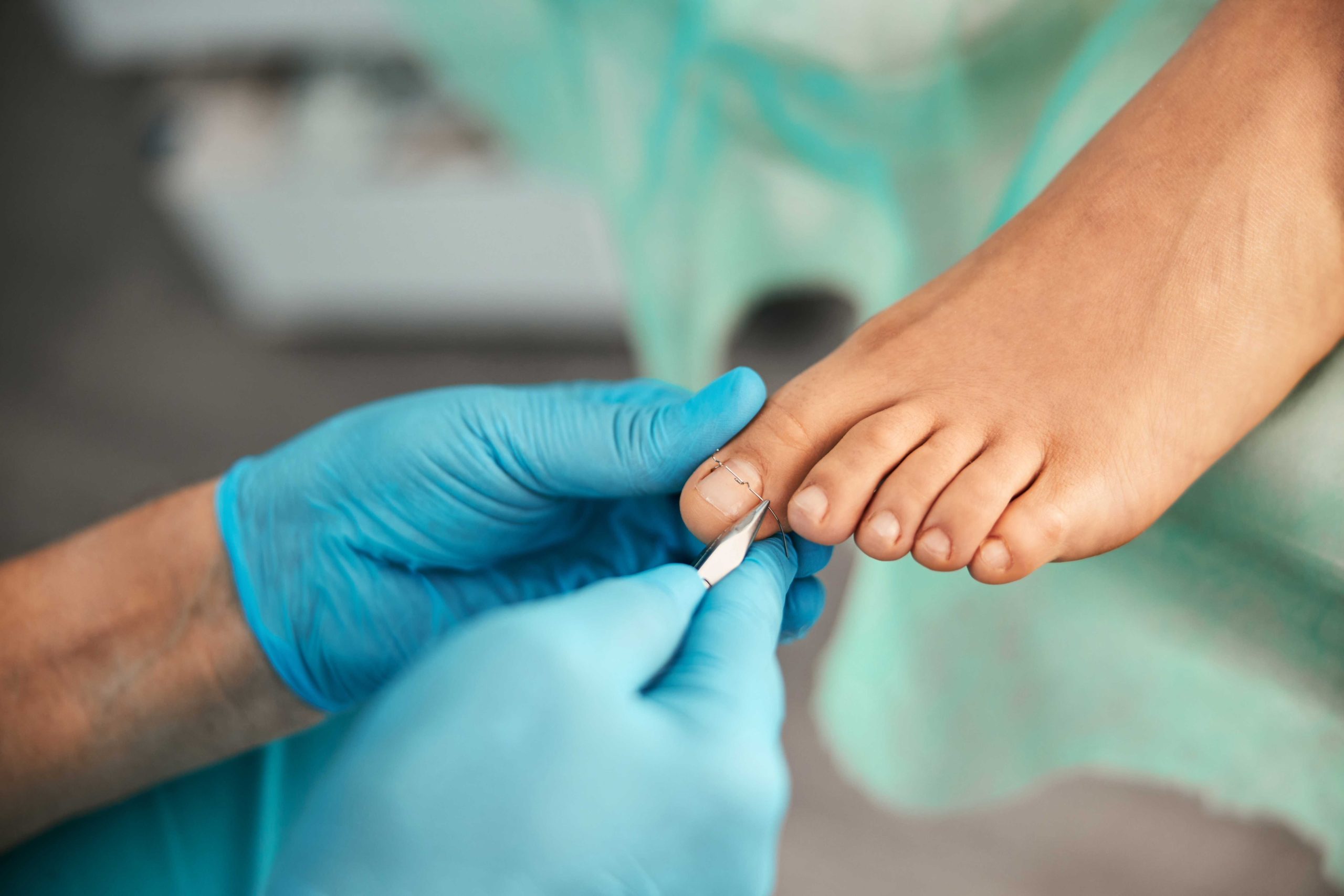 Medisch pedicure behandelt teennagel professioneel bij voetklachten bij Fysio Compleet Almelo