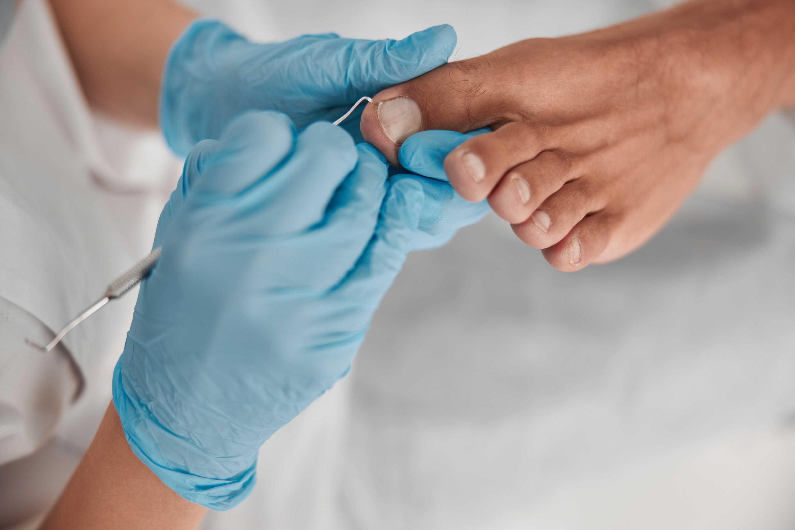 Medisch pedicure behandelt teennagel zorgvuldig bij voetproblemen en nagelklachten.